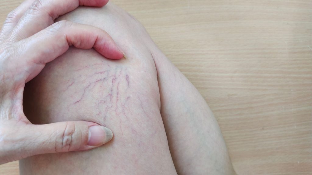 suy giãn tĩnh mạch chi dưới