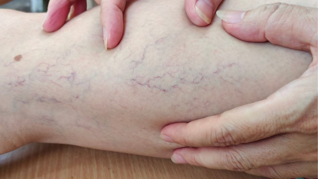 Thuốc điều trị suy giãn tĩnh mạch chi dưới